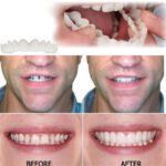Whitening Braces Simulation Teeth Denture Brace – Bild 4